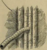 An illustration from Modern surgery, general and operative / by John Chalmers DaCosta. (1914)