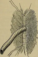 An illustration from Modern surgery, general and operative / by John Chalmers DaCosta. (1914)