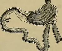 An illustration from Modern surgery, general and operative / by John Chalmers DaCosta. (1914)