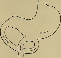 An illustration from Modern surgery, general and operative / by John Chalmers DaCosta. (1914)