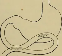 An illustration from Modern surgery, general and operative / by John Chalmers DaCosta. (1914)