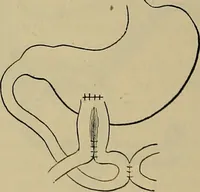 An illustration from Modern surgery, general and operative / by John Chalmers DaCosta. (1914)