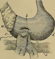An illustration from Modern surgery, general and operative / by John Chalmers DaCosta. (1914)