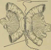 An illustration from Modern surgery, general and operative / by John Chalmers DaCosta. (1914)