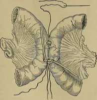 An illustration from Modern surgery, general and operative / by John Chalmers DaCosta. (1914)