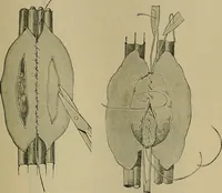An illustration from Modern surgery, general and operative / by John Chalmers DaCosta. (1914)