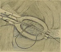 An illustration from Modern surgery, general and operative / by John Chalmers DaCosta. (1914)