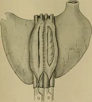 An illustration from Modern surgery, general and operative / by John Chalmers DaCosta. (1914)