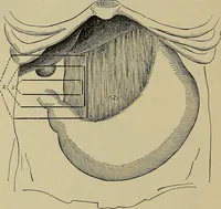 An illustration from Modern surgery, general and operative / by John Chalmers DaCosta. (1914)