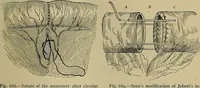 An illustration from Modern surgery, general and operative / by John Chalmers DaCosta. (1914)
