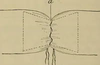 An illustration from Modern surgery, general and operative / by John Chalmers DaCosta. (1914)