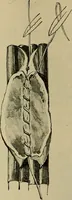 An illustration from Modern surgery, general and operative / by John Chalmers DaCosta. (1914)