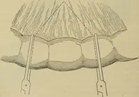 An illustration from Modern surgery, general and operative / by John Chalmers DaCosta. (1914)
