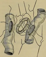 An illustration from Modern surgery, general and operative / by John Chalmers DaCosta. (1914)