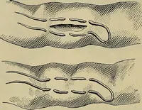 An illustration from Modern surgery, general and operative / by John Chalmers DaCosta. (1914)