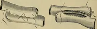 An illustration from Modern surgery, general and operative / by John Chalmers DaCosta. (1914)