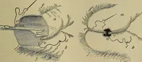 An illustration from Modern surgery, general and operative / by John Chalmers DaCosta. (1914)