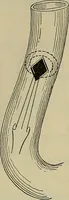 An illustration from Modern surgery, general and operative / by John Chalmers DaCosta. (1914)