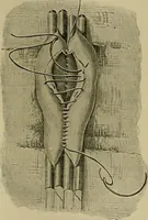An illustration from Modern surgery, general and operative / by John Chalmers DaCosta. (1914)