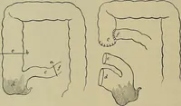 An illustration from Modern surgery, general and operative / by John Chalmers DaCosta. (1914)