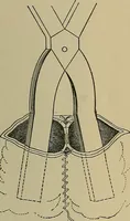 An illustration from Modern surgery, general and operative / by John Chalmers DaCosta. (1914)