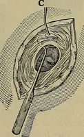 An illustration from Modern surgery, general and operative / by John Chalmers DaCosta. (1914)