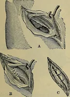 An illustration from Modern surgery, general and operative / by John Chalmers DaCosta. (1914)