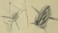 An illustration from Modern surgery, general and operative / by John Chalmers DaCosta. (1914)