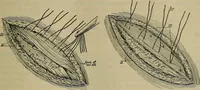 An illustration from Modern surgery, general and operative / by John Chalmers DaCosta. (1914)