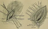 An illustration from Modern surgery, general and operative / by John Chalmers DaCosta. (1914)