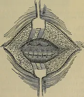 An illustration from Modern surgery, general and operative / by John Chalmers DaCosta. (1914)
