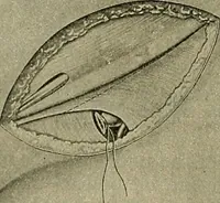 An illustration from Modern surgery, general and operative / by John Chalmers DaCosta. (1914)