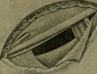 An illustration from Modern surgery, general and operative / by John Chalmers DaCosta. (1914)