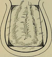 An illustration from Modern surgery, general and operative / by John Chalmers DaCosta. (1914)