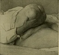 An illustration from Modern surgery, general and operative / by John Chalmers DaCosta. (1914)