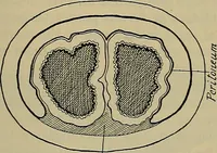 An illustration from Modern surgery, general and operative / by John Chalmers DaCosta. (1914)