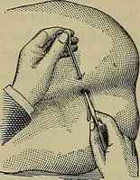 An illustration from Modern surgery, general and operative / by John Chalmers DaCosta. (1914)