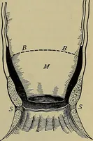 An illustration from Modern surgery, general and operative / by John Chalmers DaCosta. (1914)