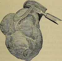 An illustration from Modern surgery, general and operative / by John Chalmers DaCosta. (1914)