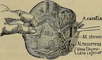 An illustration from Modern surgery, general and operative / by John Chalmers DaCosta. (1914)