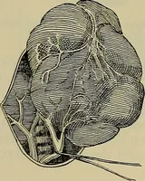 An illustration from Modern surgery, general and operative / by John Chalmers DaCosta. (1914)