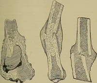 An illustration from Modern surgery, general and operative / by John Chalmers DaCosta. (1914)