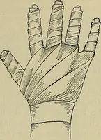 An illustration from Modern surgery, general and operative / by John Chalmers DaCosta. (1914)