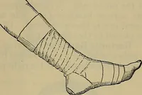 An illustration from Modern surgery, general and operative / by John Chalmers DaCosta. (1914)