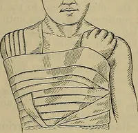 An illustration from Modern surgery, general and operative / by John Chalmers DaCosta. (1914)