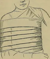 An illustration from Modern surgery, general and operative / by John Chalmers DaCosta. (1914)