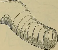 An illustration from Modern surgery, general and operative / by John Chalmers DaCosta. (1914)