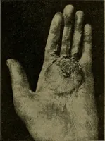 An illustration from Modern surgery, general and operative / by John Chalmers DaCosta. (1914)