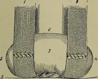 An illustration from Modern surgery, general and operative / by John Chalmers DaCosta. (1914)