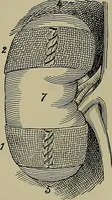 An illustration from Modern surgery, general and operative / by John Chalmers DaCosta. (1914)
